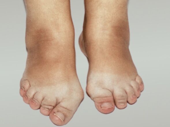 A láb artrózisa a lábujjak súlyos deformációjával