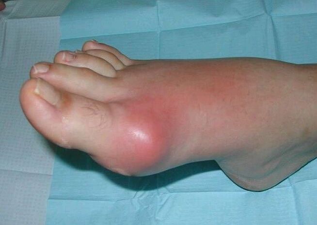 A láb ízületi gyulladásának klinikai képe - duzzanat és gyulladás