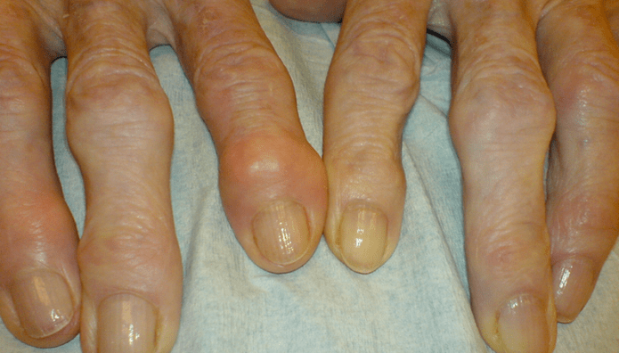 fájdalom az ujjak ízületeiben osteoarthritis esetén