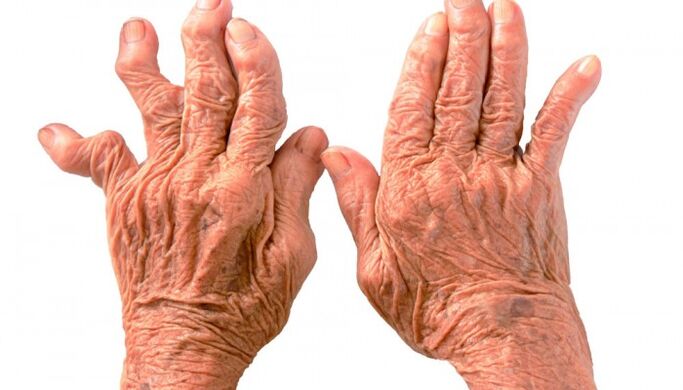 rheumatoid arthritis, mint az ujjak ízületi fájdalmának oka