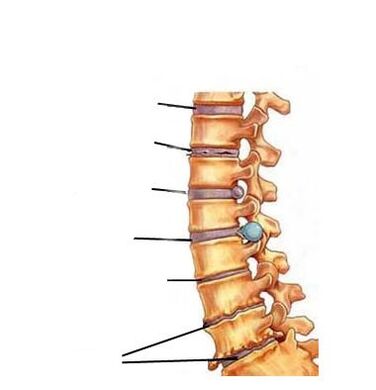 Az osteochondrosis fejlődési szakaszai
