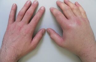 az ízületi fájdalom az ujjak ízületeiben
