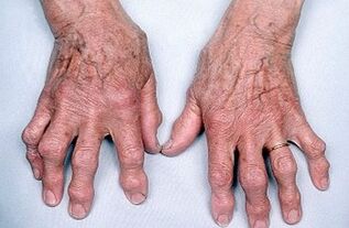 hogyan lehet megszabadulni az ujjak ízületeinek fájdalmától