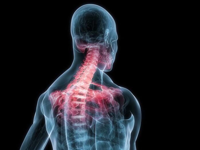A nyaki gerinc osteochondrosis az intervertebrális porckorongok módosulata