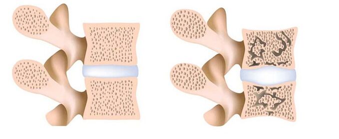 osteoporosis - a kalcium eltávolítása a csontokból