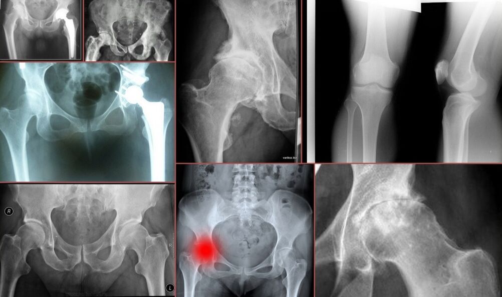 Röntgen a csípőfájdalmakra