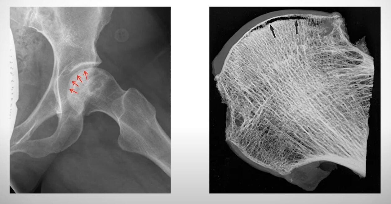 Az aszeptikus nekrózis által érintett combcsontfej röntgenfelvétele