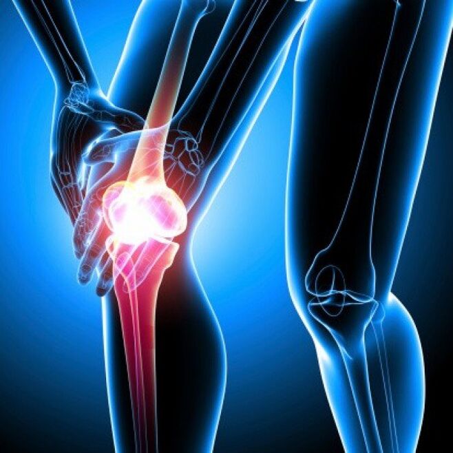 Az előrehaladott stádiumú rheumatoid arthritis csípőfájdalmat okozhat