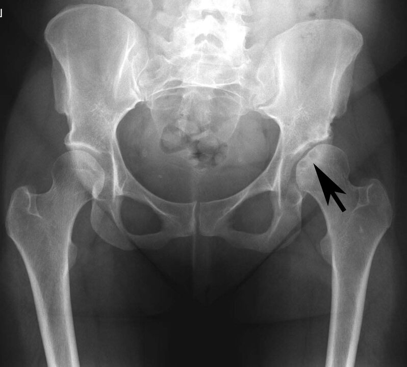 Kalcium sók lerakódása a csípőízületben pszeudogouttal röntgenfelvételen