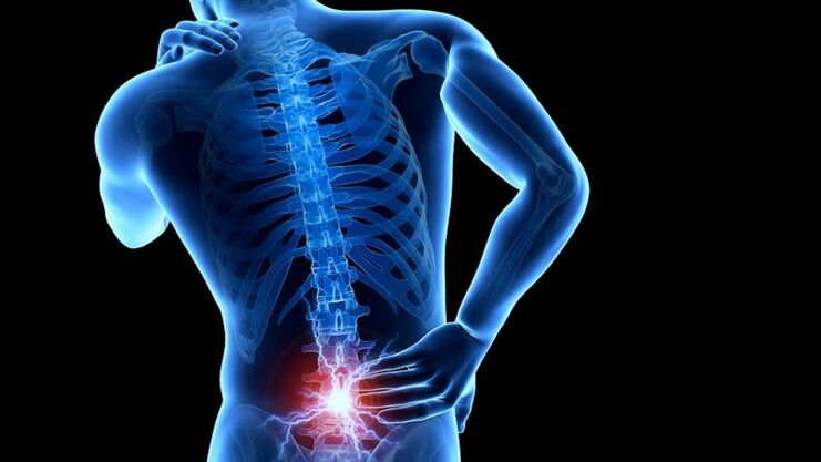hátfájás ágyéki osteochondrosissal
